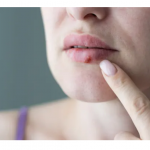 Lire la suite à propos de l’article Comment reconnaître et traiter l’herpès labial ?