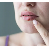 Comment reconnaître et traiter l’herpès labial ?