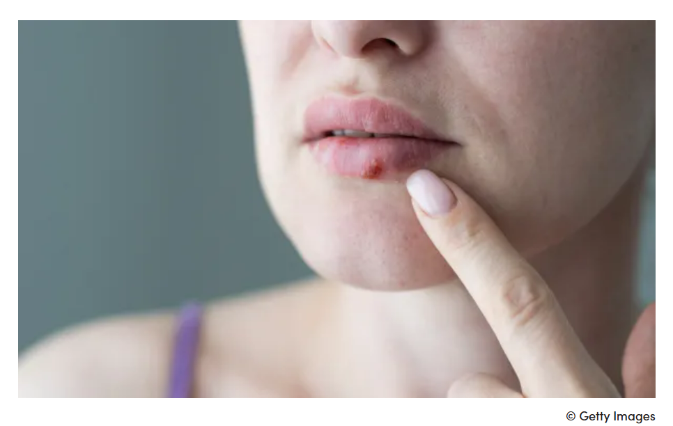You are currently viewing Comment reconnaître et traiter l’herpès labial ?