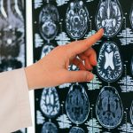 AVC : quelles sont les idées reçues sur les causes et les symptômes ?