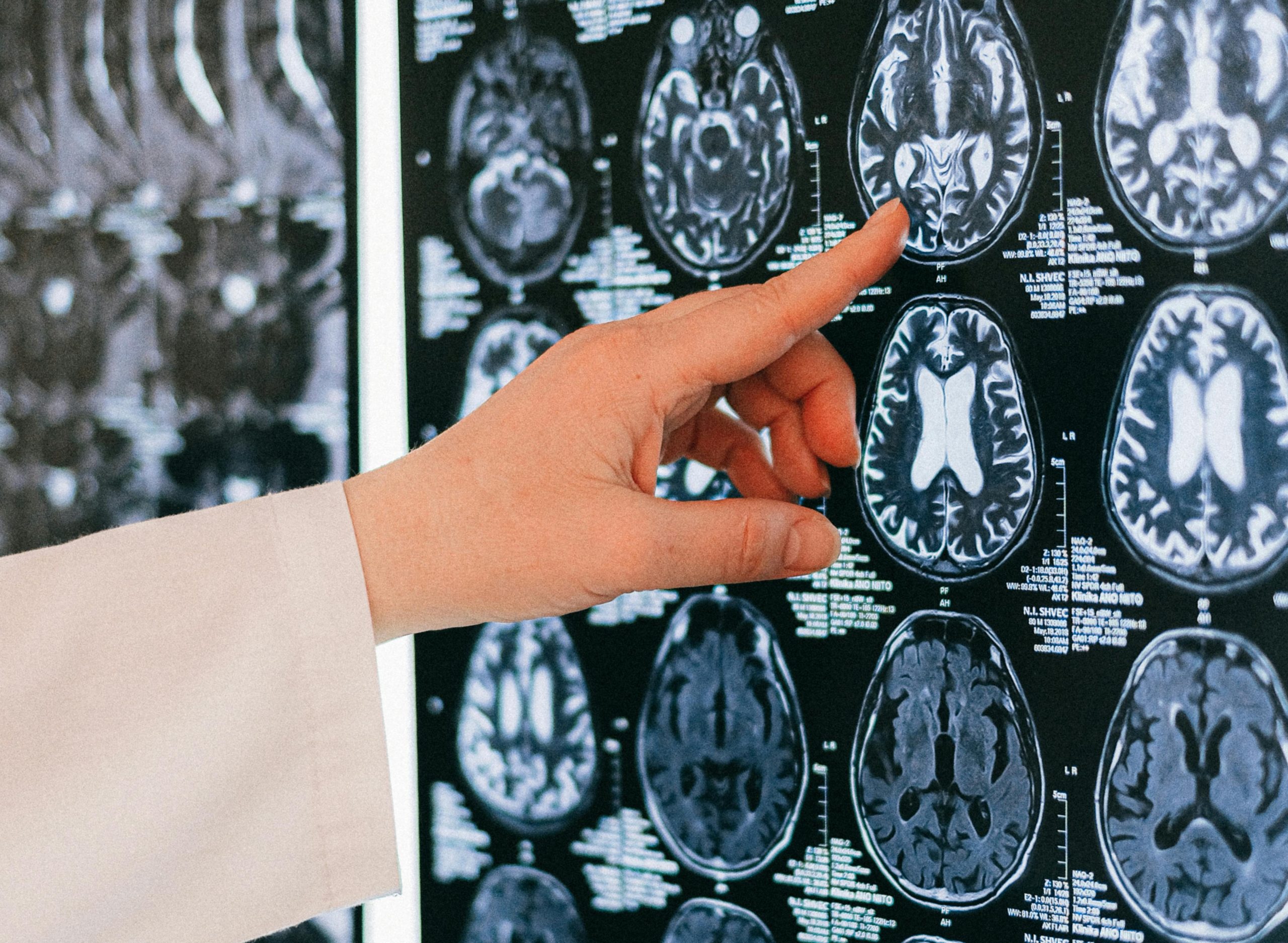You are currently viewing AVC : quelles sont les idées reçues sur les causes et les symptômes ?
